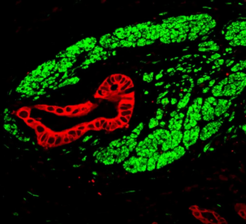 Synapsen Pankreaskarzinom 